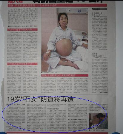 传说的<em>石女</em>图片_<em>石女</em>手术